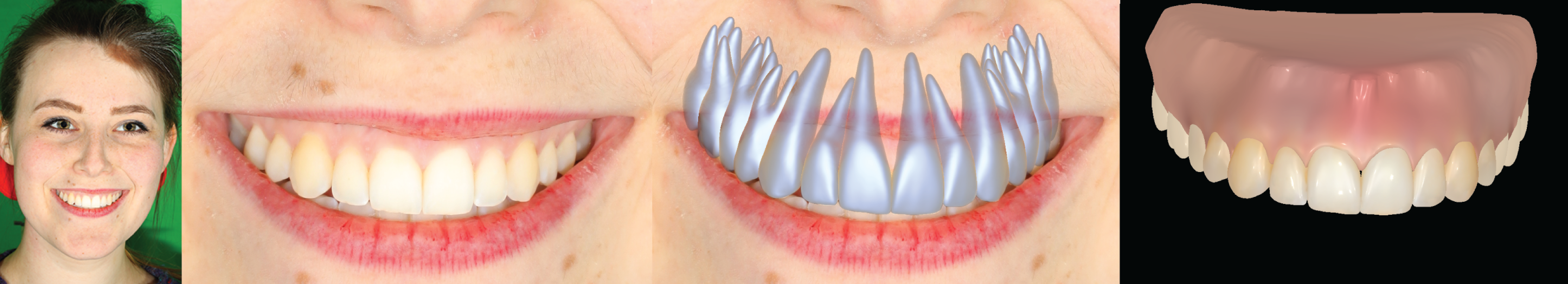 model-based-teeth-reconstruction-image